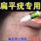 1盒体验装 去除脸部扁平疣丝状疣脖子手脚肉刺瘊子跖疣私处疣腋下身上寻常疣