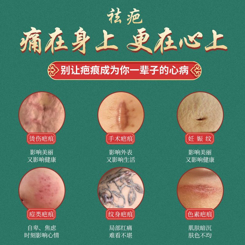 [快速去疤]淡化增生凹凸疤妊娠纹去新老疤烧伤痘印疤膏修复无痕 升级装一瓶装