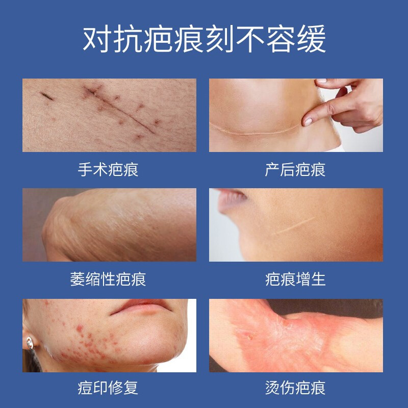 祛疤膏 进口硅酮 修复凹凸增生疤痕去脸部痘印手术伤疤除疤医用