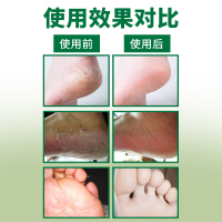 CVKK脚气膏30g*3盒 脚气止痒膏真菌感染脱皮烂脚丫脚臭脚痒水泡型脚烂狼毒抑菌杀菌除水泡型足部护理用品