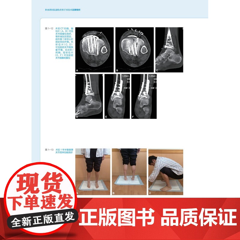 积水潭医院创伤骨科手术技术 足踝骨折 北京积水潭医院手术经验全景展示 北京科学技术高清大图