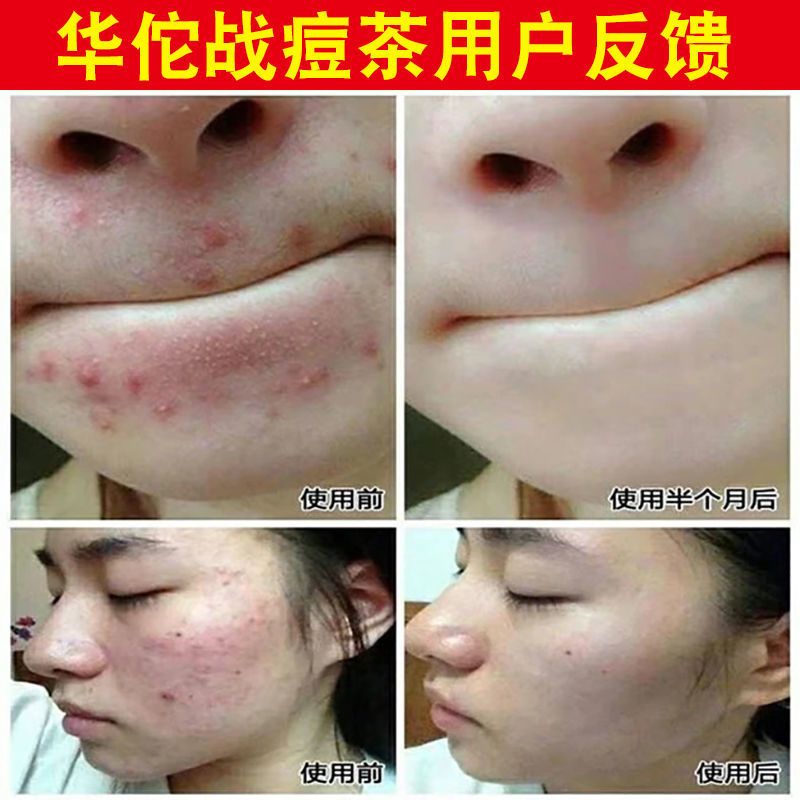 古方祛痘茶排毒痘痘茶下火男女通用养颜内调降火内分泌清火祛痘茶 一盒体验装(不保证效果)
