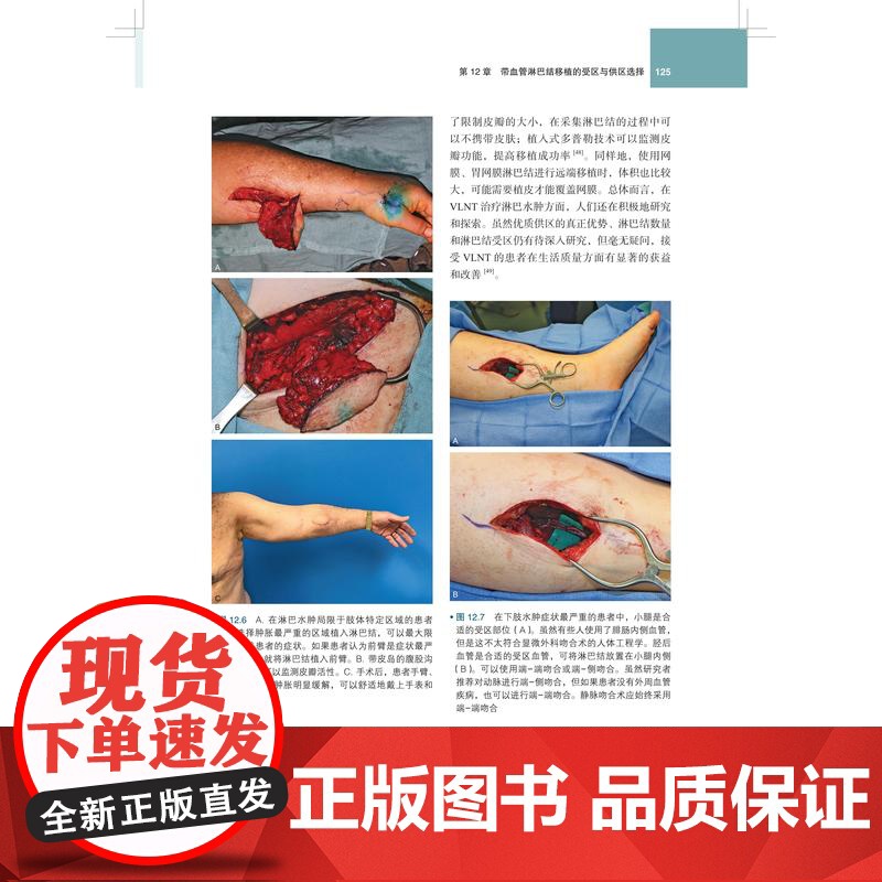 淋巴水肿外科原则与手术技巧 上海科技出版社多国权威专家诊治经验研究指南参考治疗方法理念领域手术技巧高清大图