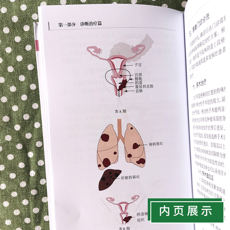 [正版]妇科肿瘤诊治流程 逸仙妇瘤诊疗规范丛书 卢淮武 陈勍 妇产科学 围手术期的处理病理放疗化疗等诊治人民卫生出版社高清大图