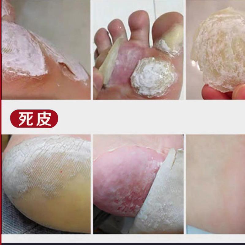 鸡眼软化消除旧茧去除脚茧手茧去脚死皮老茧脚底增厚陈年脚垫老茧鸡眼