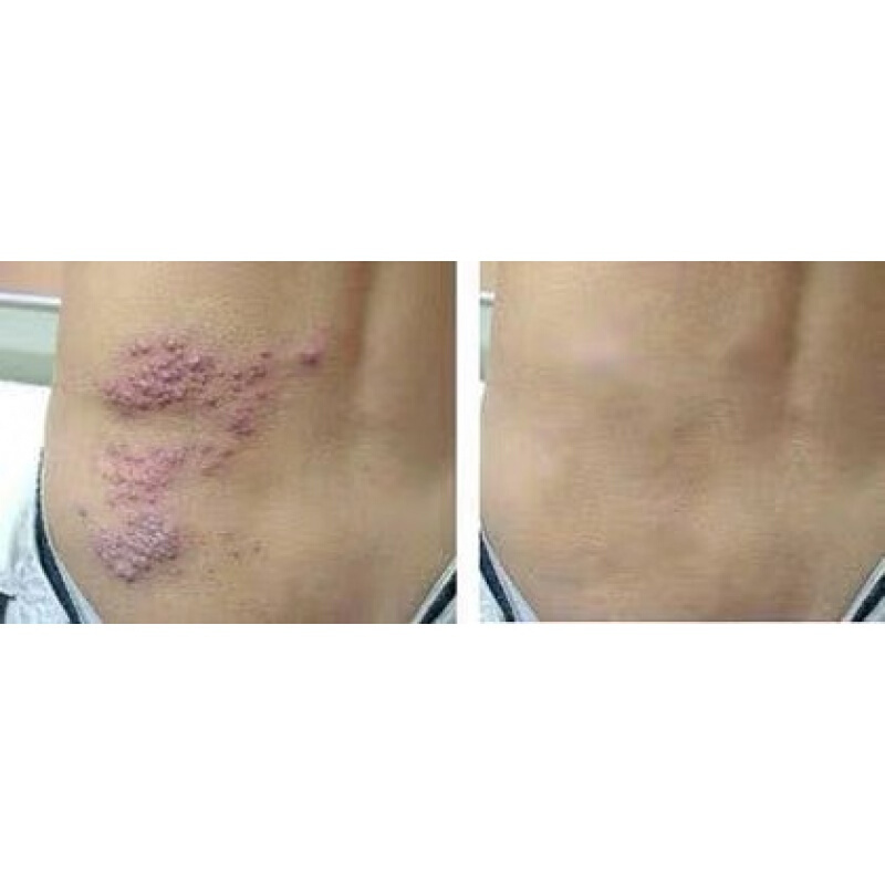 胡克蛇七号常民膏 疱疹带状蛇盘疮蛇缠腰过敏修复皮肤外用止痒膏软膏