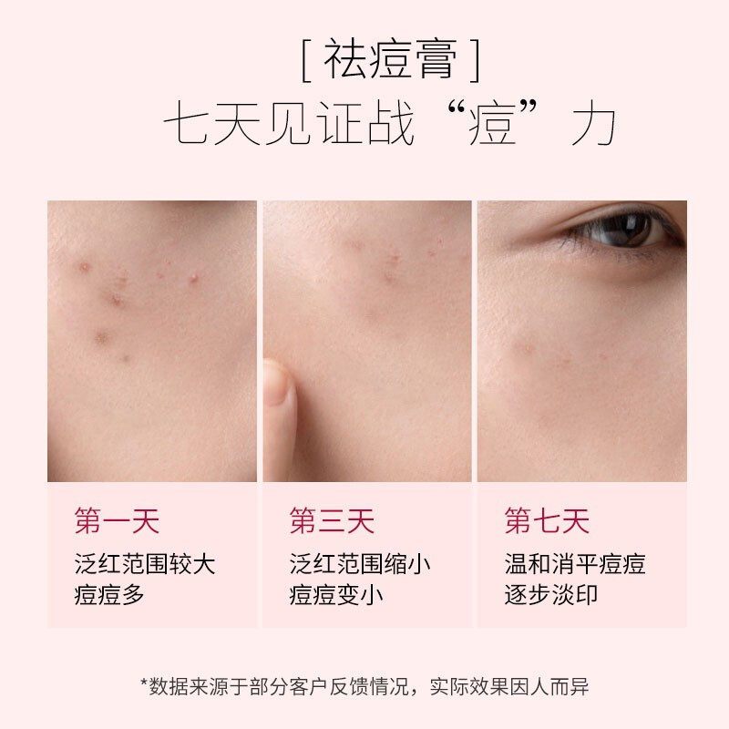 仁和祛痘型冷敷凝胶*2支装去痘印去痘坑痘疤医用修复祛痘神器祛痘凝胶[20g/支]