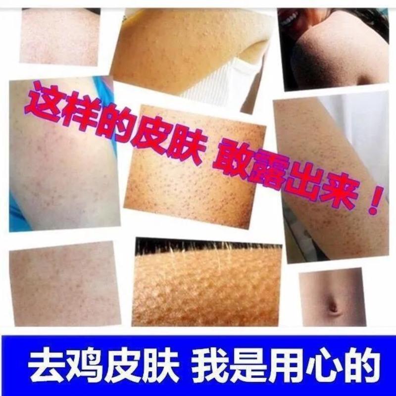 其他/other 30g 鱼鳞皮肤霜身体乳去鸡皮疙瘩毛囊角化角质救星病祛蛇皮腿去除克星