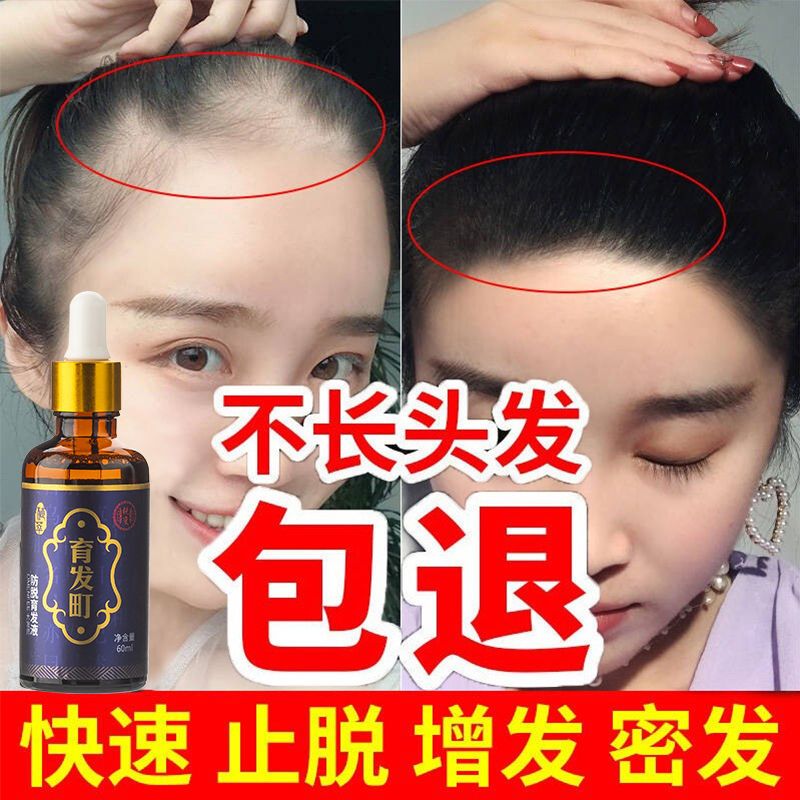 [优先发货][快速长发]防脱发洗发水纯生发增发密发斑秃脂溢性育发液防发 3周期装(严重脱发使用)