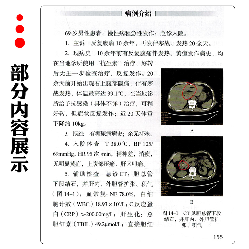 [正版]胆道感染疑难病例解析 人民卫生出版社9787117341165高清大图