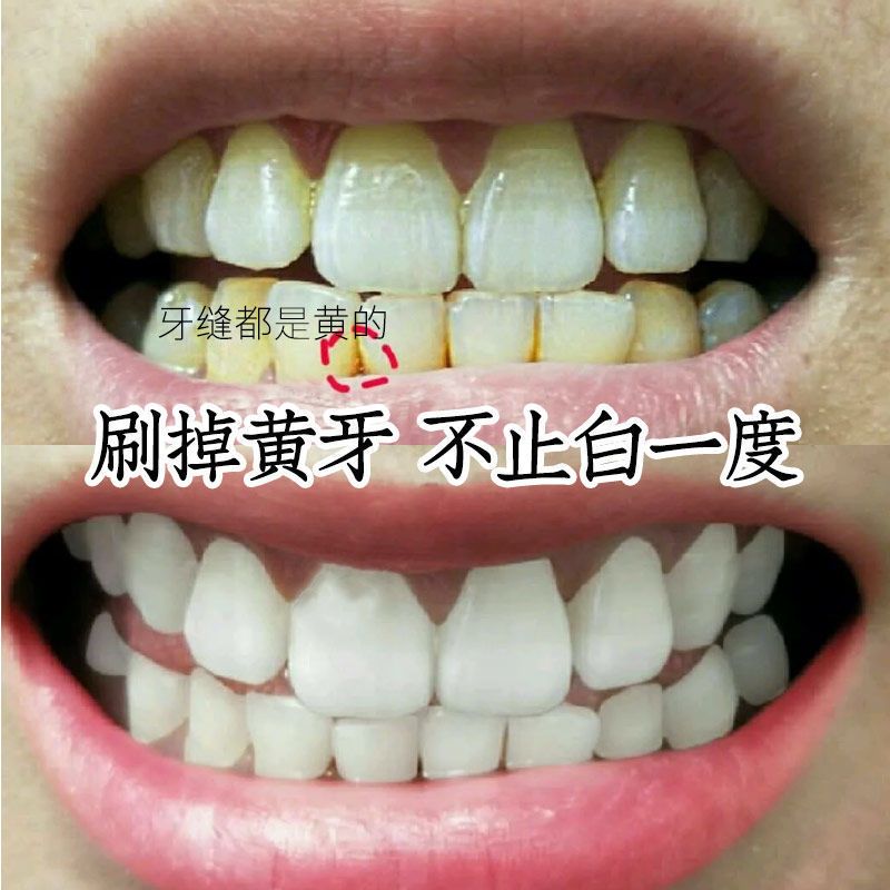 洗牙粉牙齿美白去黄洗白污垢除牙石刷洁牙结石烟牙渍去除牙黄神器 牙粉1盒/50g[体验装]