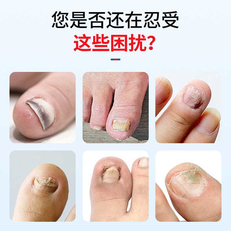 海氏海诺 灰指甲护理盒手脚灰趾甲修甲刀打磨锉刀修剪清除护理组合护理盒套装高清大图