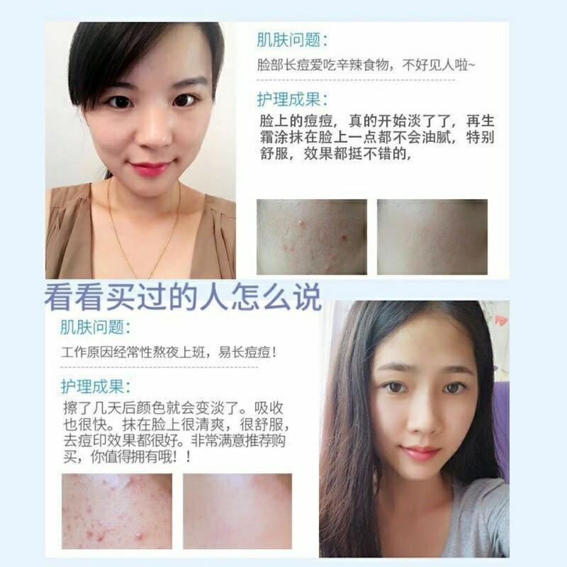 祛痘神器青春痘学生粉刺祛痘膏祛痘印痘坑修复草本无激素安全 祛痘膏1支[体验装不推荐]
