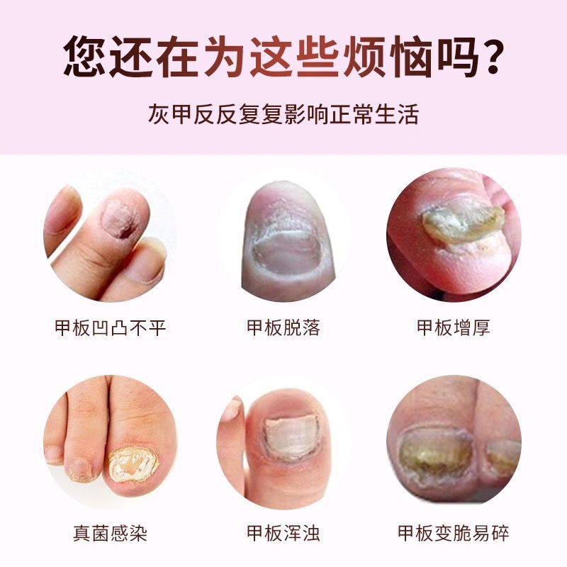 1盒 [轻度灰指甲]送挫刀+黏胶 [同仁堂]灰指甲特效液增厚灰甲亮甲去除灰指甲专用脱甲油抑菌液