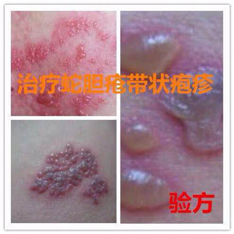 加丹状肤宁蛇盘疮蛇盘丹清蛇胆疮缠腰蛇泡疹病毒神后遗症经痛带状疱肤康喷剂