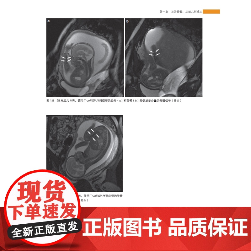 小儿与成人骨髓MRI诊断图谱 正常表现、变异和弥漫性病变 图文结合医学专著 广东科技出版社店发货高清大图