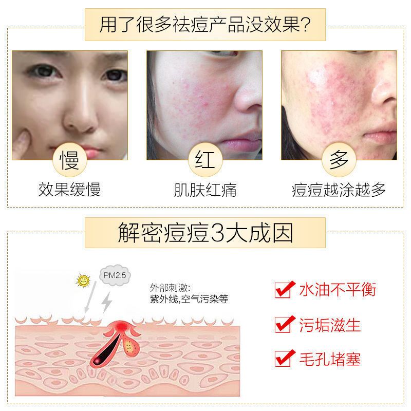 曼秀雷敦乐肤洁抗痘护理啫喱淡化痘印青春痘学生凝胶 抗痘啫喱18g