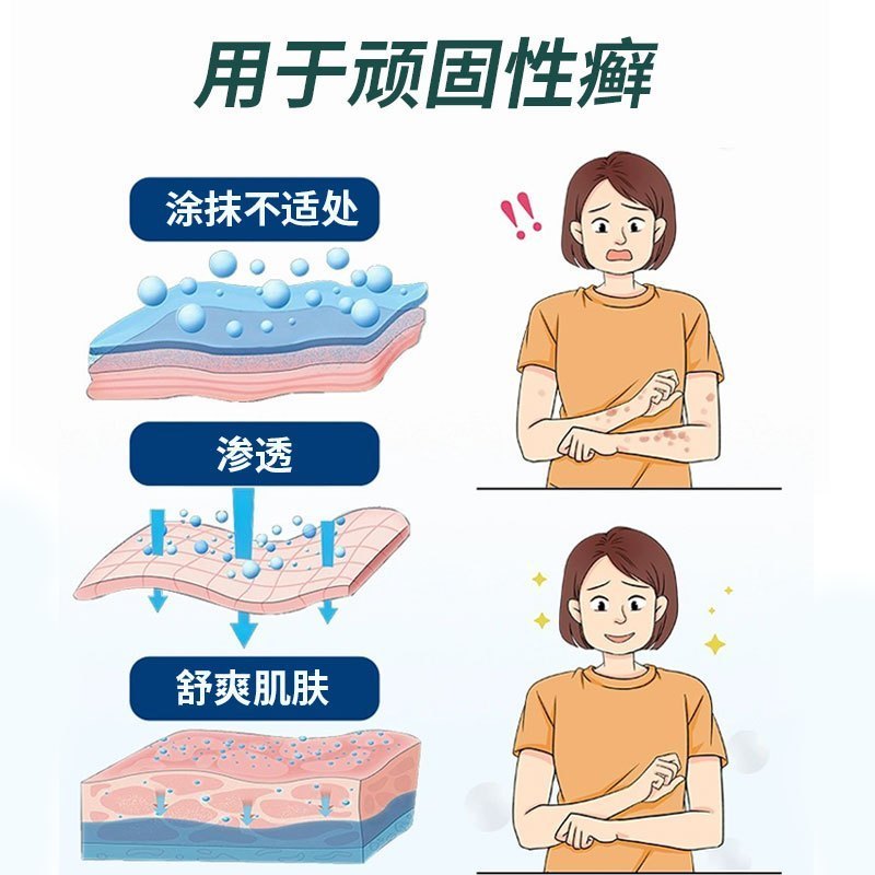 周郎中牛皮癣银屑专用手足癣大腿内侧股部全身皮肤瘙痒外用止痒