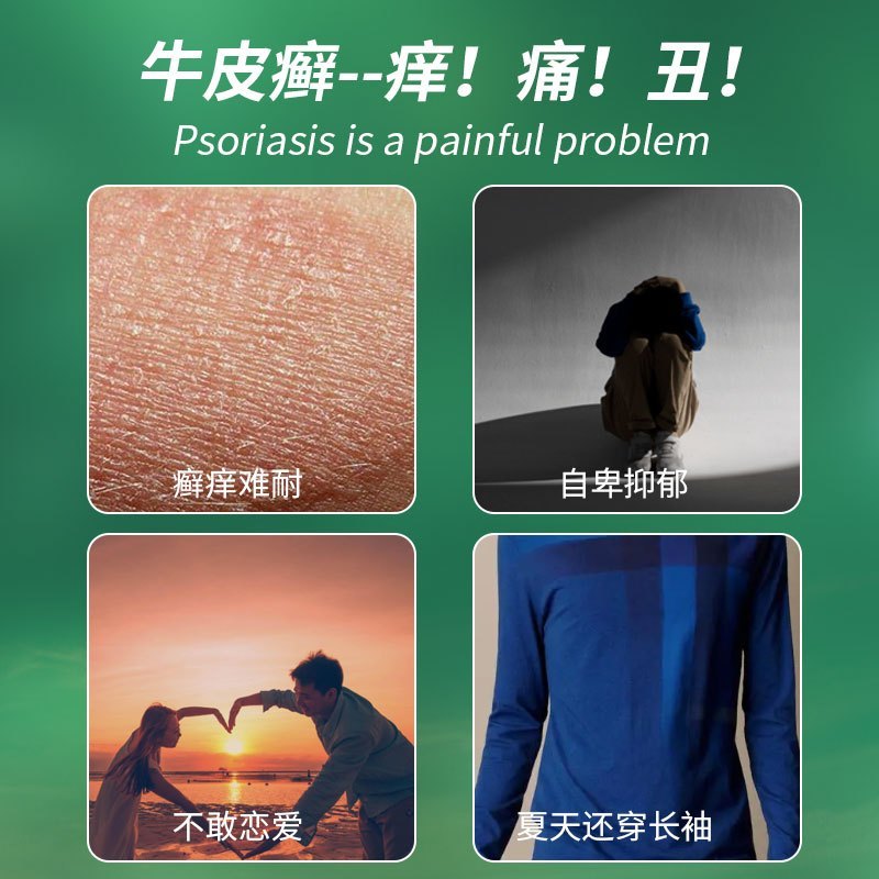 周郎中牛皮癣银屑专用手足癣大腿内侧股部全身皮肤瘙痒外用止痒