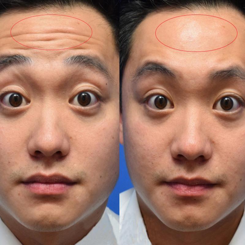 新年礼物抬头纹祛皱女去额头纹贴神器川字纹去皱纹男礼品10片一盒5