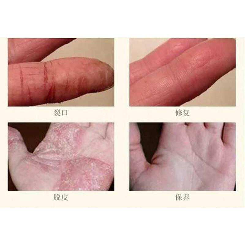 手气手干脱皮药膏手痒脱皮干裂手上干燥起皮小水泡止痒膏汗孢疹手气
