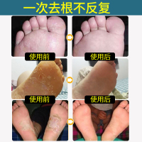 采药师 脚气喷剂草本抑菌喷剂止痒膏去除脚痒脱皮水泡脚其他臭烂脚丫子 60ML