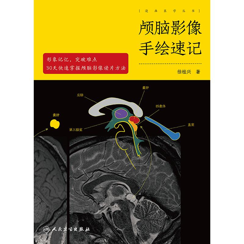 颅脑影像手绘速记 颅脑正常影像 高血压性脑出血 脑静脉出血和静脉窦血栓形成 颅内肿瘤 主编 徐桂兴 9787117 [正高清大图