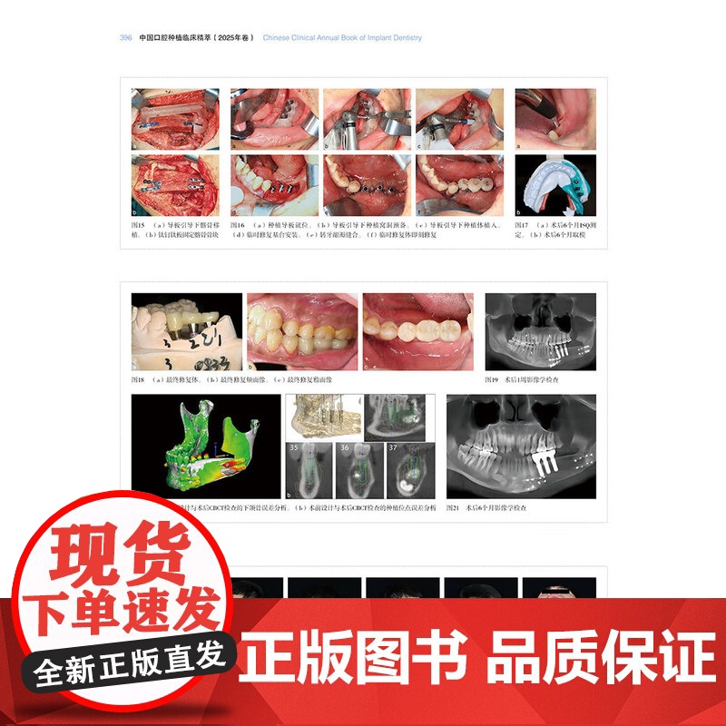 [出版社]中国口腔种植临床精萃 2025年卷 王兴 刘宝林 第13次BITC口腔种植病例大赛将获奖病例收集成册 辽宁科学高清大图