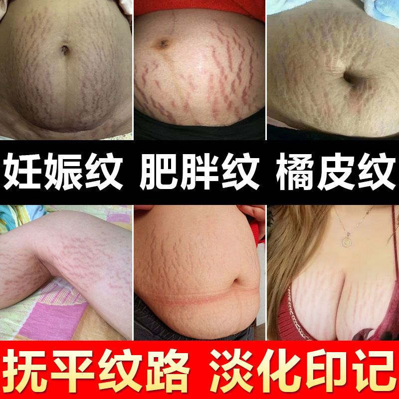 祛妊辰修复霜预防孕妇产后专用消除紧致淡化肥胖生长妊娠纹橄榄油