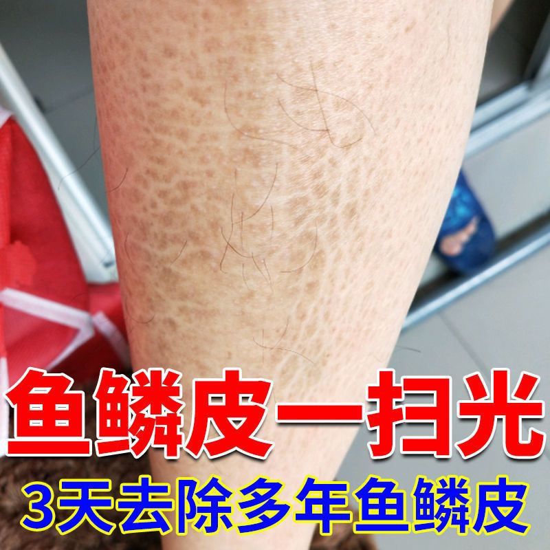 [一抹掉光鸡皮]鱼鳞皮肤霜草本润肤保湿皮肤干燥身体乳皮肤修复 一瓶[开始体验装]