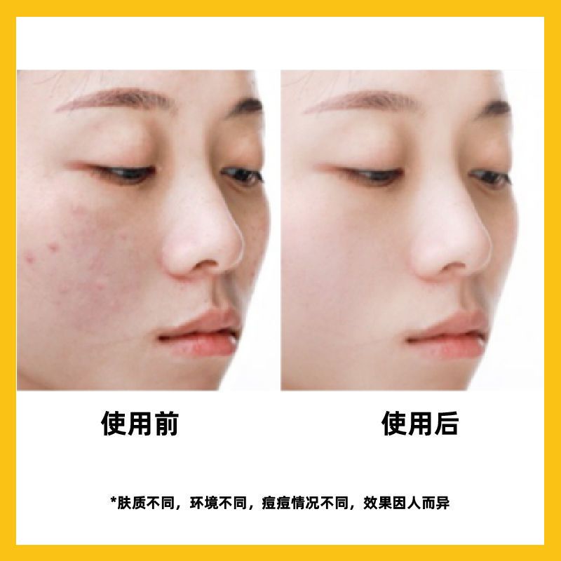 科凌虫控除螨皂拉丝洁面祛痘除螨虫面部女清洗深层清洁手工香皂男 1快装(送起泡网)
