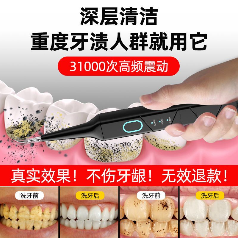 胖猫清洁牙结石去除器家用超声波洁牙器烟渍洗牙机电动牙刷牙神器 洁牙神器丨收藏丨优先发货 基础黑丨配尖头+刷头