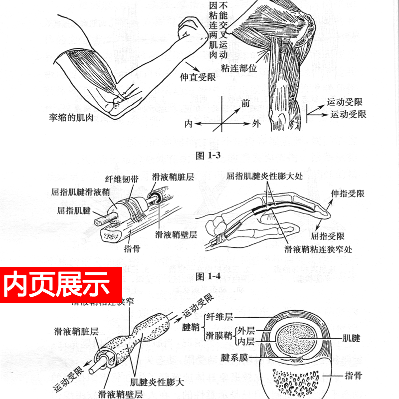 针刀临床诊断与治疗第二版朱汉章柳百智人民卫生实用小针刀书籍疗法治疗学基书籍医学自学入门中医针灸高清大图