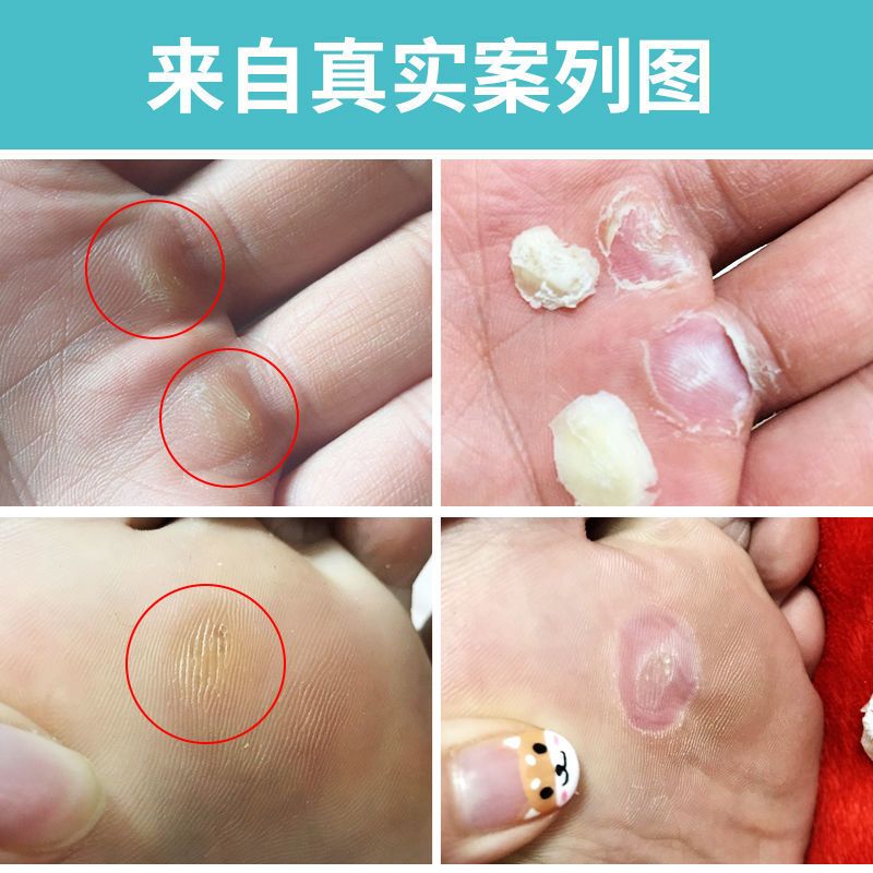 鸡眼软化消除旧茧去除脚茧手茧去脚死皮老茧脚底增厚陈年脚垫老茧鸡眼