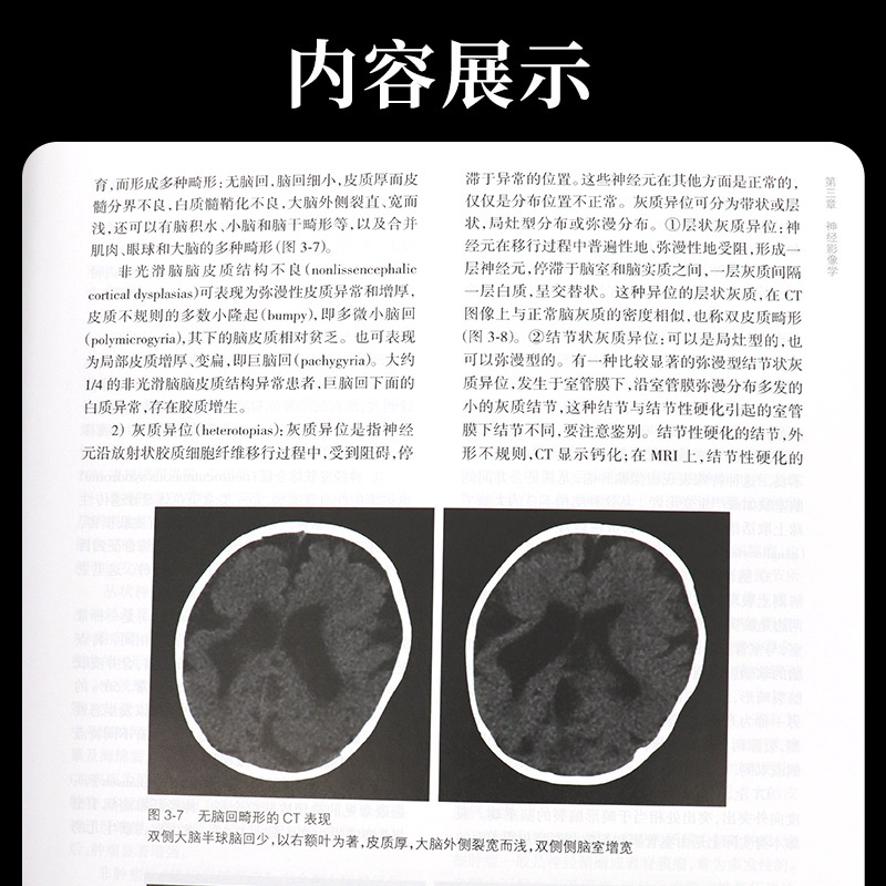 [正版]儿童神经病学 第3版 第三版 包 姜玉武 神经内科外科学遗传咨询癫痫遗传学脑白质病早期发育儿科临床实用书籍 人高清大图