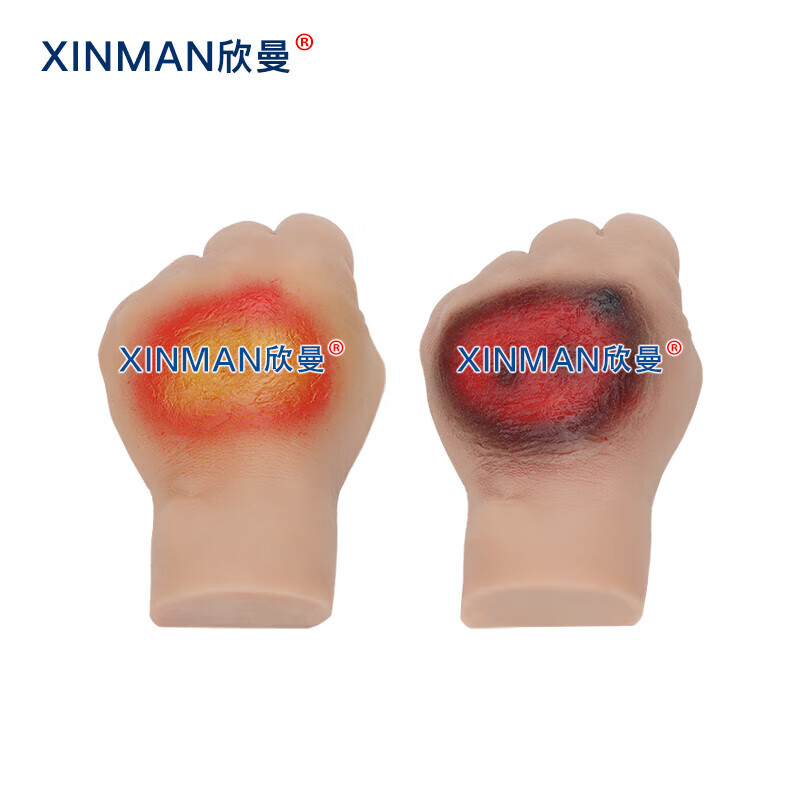 欣曼科教 人员中毒仿真模型 神经性中毒 芥子气中毒 路易氏剂中毒 教学用模型XM-SQ16A高清大图