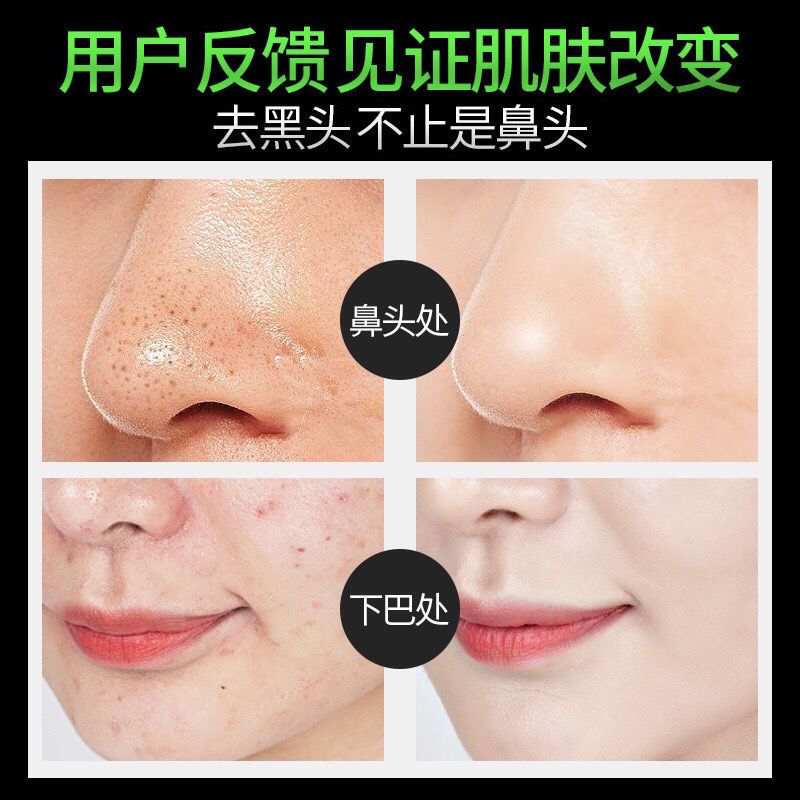 竹炭去黑头三件套 李佳琦推荐竹炭去黑头粉刺套装清洁收缩毛孔精华控油撕拉式鼻贴膜