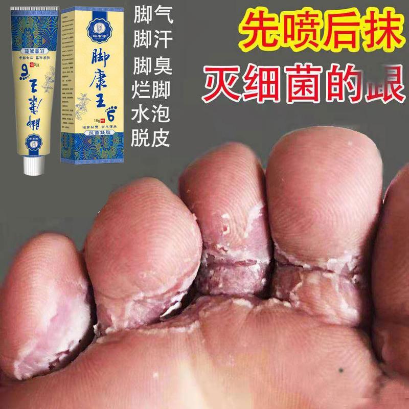 脚气膏一支脚气喷剂永去脚气脚痒脚烂复发去脚气臭脚汗烂脚丫水泡脱皮