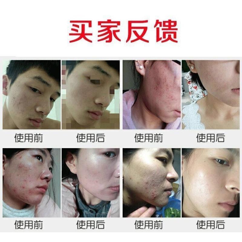快速祛痘膏男女学生祛痘印产品去痘印修复痘坑青春痘去痘痘膏套装 (轻度)祛痘
