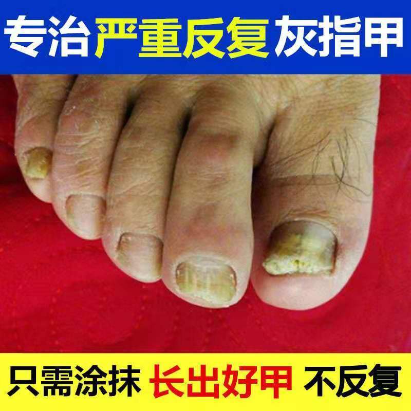 [医师推荐]治疗灰指甲特效去除增厚亮甲灰指甲专用液抑菌液 1瓶[5ml体验无]