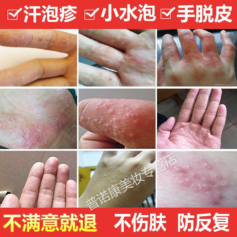 治手痒起水泡手脚脱皮的药干裂起皮手足癣手气手湿疹皮肤止痒药膏