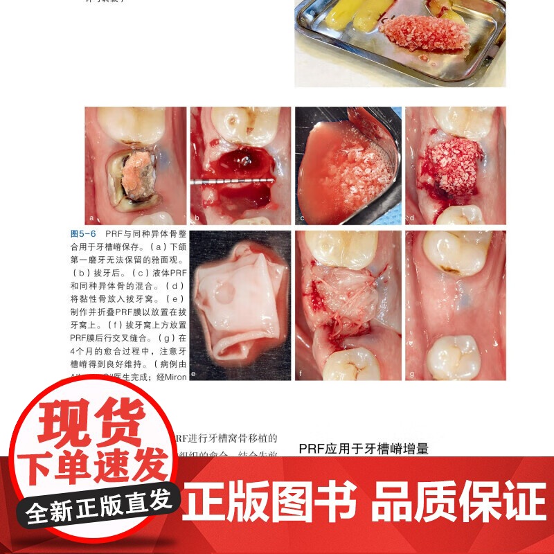 [出版社]水平与垂直骨增量在种植治疗中的应用 克雷格·米施 骨科学种植体植入钛网骨移植口腔牙体牙髓 辽宁科学技术出版社高清大图