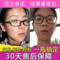 去痘洗面奶男士痘印痘疤去黑头螨虫祛除粉刺控油学生女祛痘坑