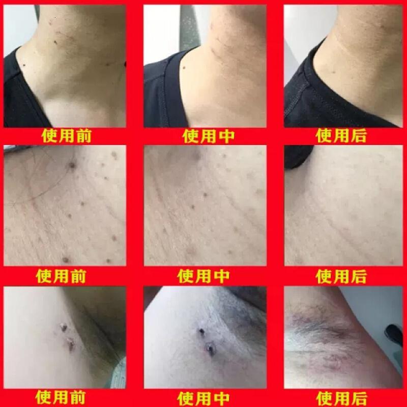 颈部腋下肉粒去除点猴子疙瘩颈部腋下脖子小肉粒丝状尤刺猴肉瘤痣膏