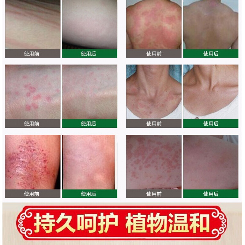 蛇盘丹奇方后遗症缠腰蛇神经痛外用治带状疱疹蛇盘疮