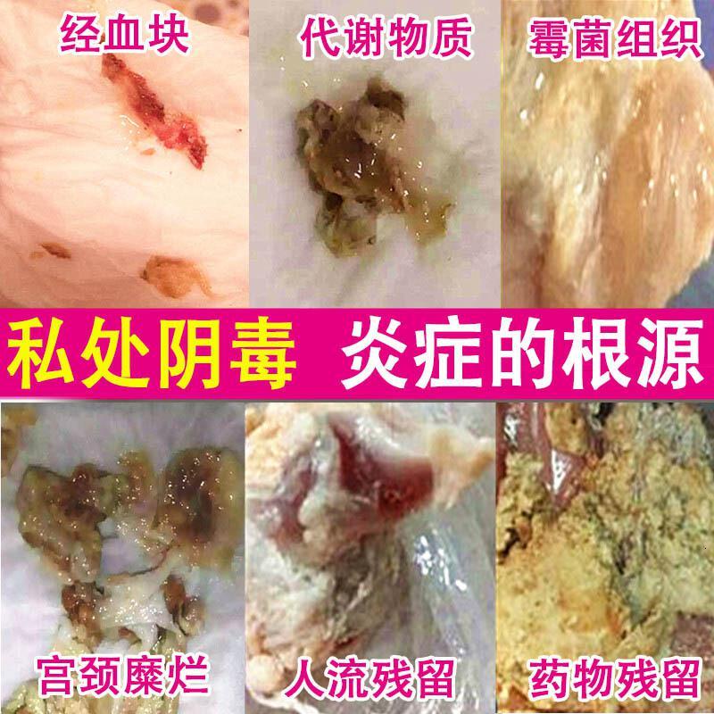 雅美肤金鸡妇科凝胶正品女性私处部护理外瘙痒霉菌性炎症白带豆腐渣