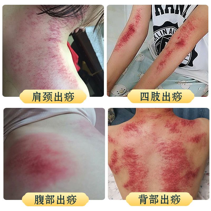 碳化元宝刮痧板刮痧仪器淋巴排毒肩颈全身通用舒筋活络美容院养生单个