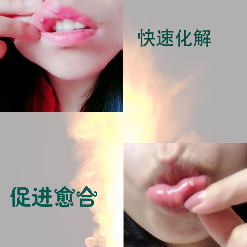 清火去口腔上火溃苔痛藓疡除口臭烂白嘴点角舌头疮起泡非药漱口水