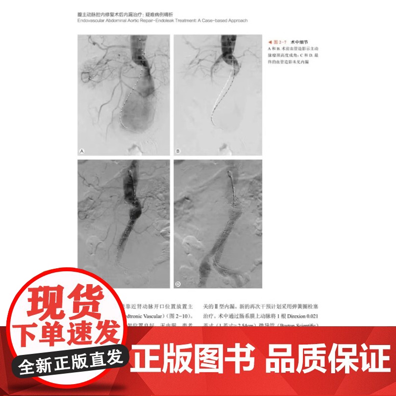 DF[央视网]腹主动脉腔内修复术后内漏治疗:疑难病例精析 9787523601679 中国科学技术出版社 内科学 大动脉高清大图