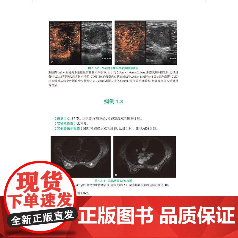 全2册 乳腺疾病超声图解100例+乳腺MRI解读:筛查和诊断住院医师超声医学PBL教学培训系列教程 超声诊断典型病例高清大图